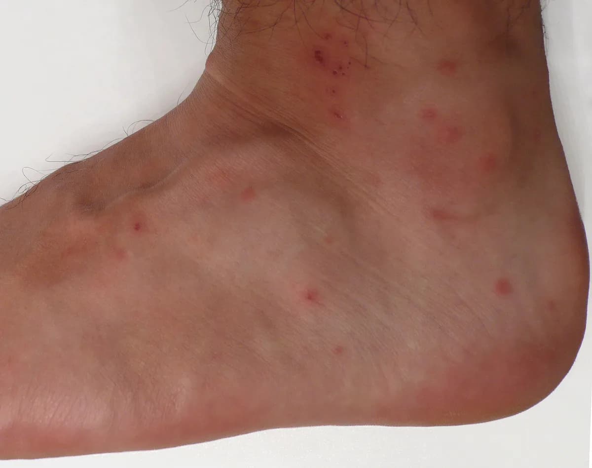 Chigger bites on a foot and ankle showing scattered red welts